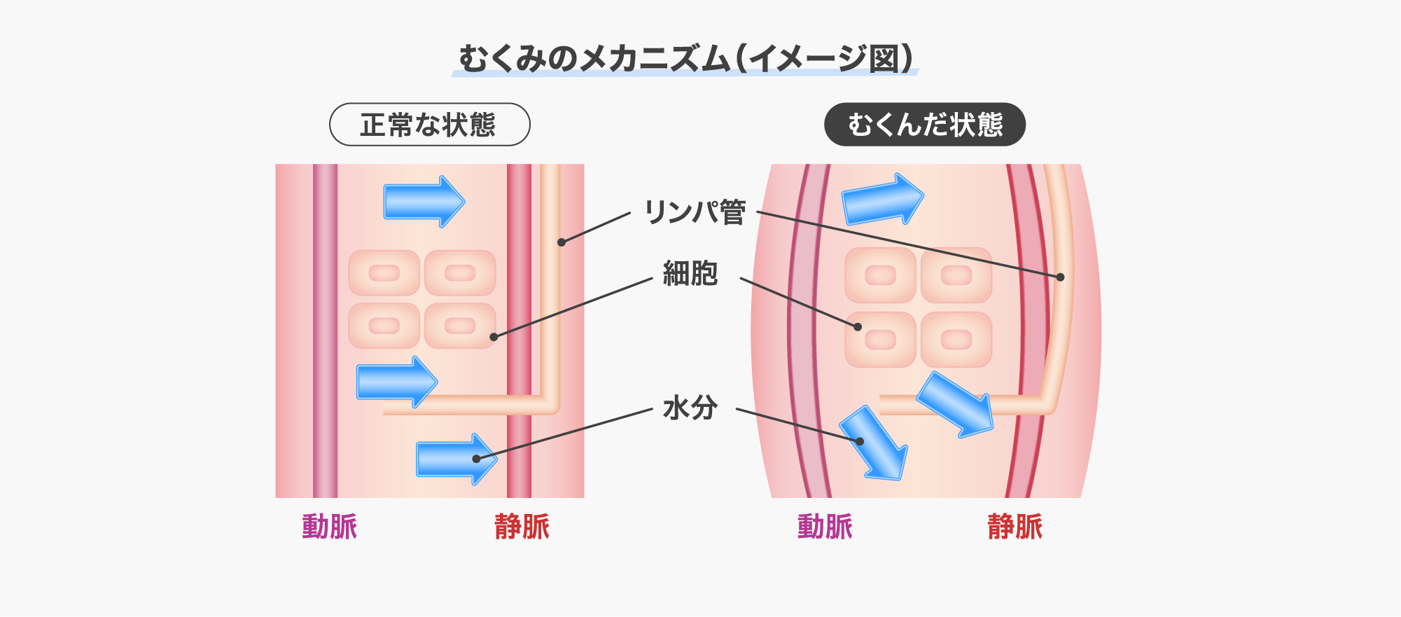 むくみのメカニズム（イメージ図）